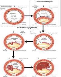 Unstable angina is regarded as an extremely dangerous stage of exacerbation of coronary heart disease in terms of clinical manifestations and prognostic value, unstable angina takes an intermediate place between stable angina and acute myocardial infarction, but, unlike a heart attack. Ischemic Heart Disease Disorders Of Organ Systems Pharmacotherapy Principles And Practice Second Edition Chisholm Burns Pharmacotherapy 2nd Ed