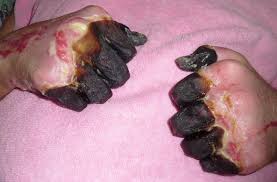 The bacteria then multiply in the lymph node closest to where the bacteria entered the. Yersinia Pestis Infection Physical Examination Wikidoc