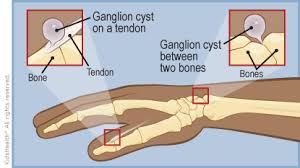 It has been days and that annoying cyst is still of the same size; Ganglion Cysts For Parents Nemours Kidshealth