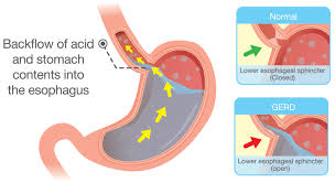 acid reflux in babies causes symptoms and treatment