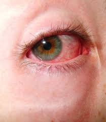 You Really Shouldn T Be Sleeping In Your Contacts And Here S Why Natural Pink Eye Remedy Natural Remedies Natural Home Remedies