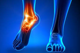 After the surgery, your foot will be wrapped up in a large, bulky splint or soft dressing to protect the foot and ankle. How To Prepare For Recovery Time For Total Ankle Replacement Rothman Orthopaedic Institute