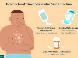 Colored or pityriasis versicolor is a fungal recidiviruyuschee skin disease. Best Treatments For Tinea Versicolor Skin Infection