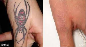 Laser Tattoo Removal Before And After Photos Premium Tattoo Removal