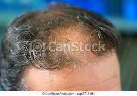 Read how zincplex scalp products help! Male Head With Hair Loss Symptoms Front Side Canstock