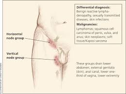 In addition to disorders of the stool, the patient has nausea and vomiting, swelling and abdominal pain. Unexplained Lymphadenopathy Evaluation And Differential Diagnosis American Family Physician