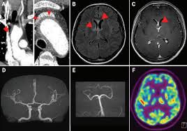 The inflammation causes the brain to swell, . Encephalitis