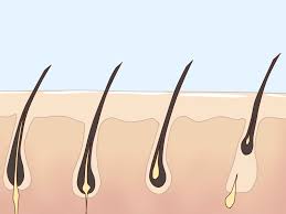 The damage caused by it stops the hair from growing back. 5 Ways To Get Rid Of Body Hair Wikihow