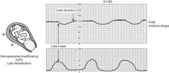Image result for Late Deceleration