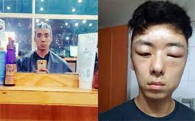 Still, it can prove to be just as. Scary Hair Dye Allergy Made This Guy Go From That To This Lifestyle News