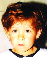 Patient at age 5.5 years. Figure 2. Patient at age 20 years.