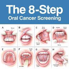 If the sore bump on roof of mouth, patch on tongue, mass formed on gums, swelling or color changes inside the mouth do not go away even after the passage of a few weeks then they should be evaluated by a doctor. Baton Rouge La Oral Cancer Screening Juban Cowen Dental Care