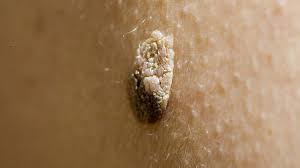 Hpv feigwarzen behandlung, hpv warzen am fu? Haut Hpv Viren Rufen Warzen Hervor Dlf Nova
