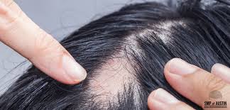 The most prominent symptom of alopecia areata is patchy hair loss. What Are The Initial Symptoms Of Alopecia Areata In Men And Women Smp Of Austin