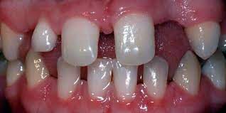 Hypodontia Missing Teeth Kids Dental Plano And Carrollton Dr Jeff Holt