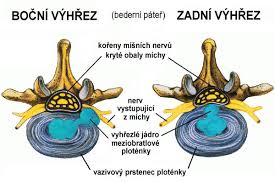 Image result for vyhřezlá ploténka
