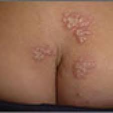 All natural cure for herpes hsv formula, how long does a outbreak of. Recurrent Vesicular Rash Over The Sacrum Mdedge Family Medicine