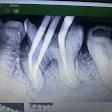 Painless rootcanal product image