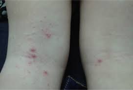 Anything you see advertised on the internet for use at beetlejuice (aka cantharone) this treatment is our favorite because it is effective and it does not hurt. The Infectious Complications Of Atopic Dermatitis Annals Of Allergy Asthma Immunology