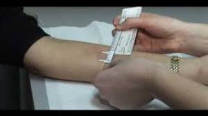 In the following test, we ask for symptoms that may occur in ppd. Tb Skin Test Mantoux Method Youtube