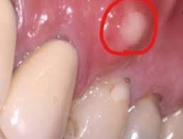 Image result for Periodontal Abscess