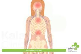Instructivo de esclerosis lateral amiotrofica. Amyotrophic Lateral Sclerosis Als And Medical Cannabis Kalapa Clinic