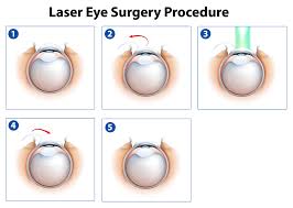 Specialty contact lenses like torics or multifocals can cost even more. How Much Does Lasik Cost Access 2 Knowledge