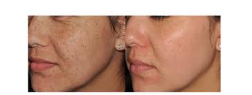 Skin Rejuvenation Using Lumecca IPL Technology I InMode