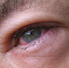 Als gerstenkorn wird eine akute, plötzlich auftretende und schmerzhafte schwellung am lidrand. Augenmedizin Antibiotika Bei Gersten Und Hagelkorn Nicht Immer Notig Welt