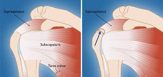 Maybe you would like to learn more about one of these? Rotator Cuff Tears Orthoinfo Aaos