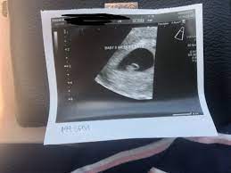 Indeed, what does it look for the assessment of your zest for an this scan offers. 6 Week Dating And Viability Scan And Nausea September 2019 Birth Club Babycenter Australia