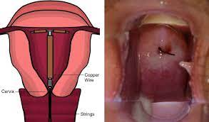 Nonvisualized strings also may indicate the uncommon complications of pregnancy, iud expulsion, or uterine. Fitting An Intrauterine Device Or Intrauterine System Teachmeobgyn