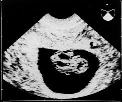 Learn step 2 and shelf essentials in a free 10 min video. Pregnancy Outcome Of Embryonic Fetal Pleural Effusion In The First Trimester Hashimoto 2003 Journal Of Ultrasound In Medicine Wiley Online Library