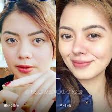 People Who Got Plastic Surgery In Their 20s