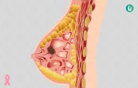 Hope you can give me some advise. Breast Cancer Symptoms Causes Treatment Medicine Prevention Diagnosis