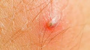 Wash the affected area with warm water and exfoliating scrub. Ingrown Hair Drawing Cream Ingrown Hairs