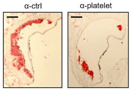 Myocardial infarction, acute myocarditis, cardiac tamponade (and other causes leading to a acute weakening of the contractility of. Hardening Of The Arteries Platelets Inflammation And A Rogue Protein Conspire Against The Heart