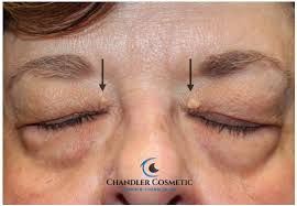 Image result for xanthelasma of eyelid