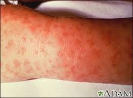 Rocky mountain spotted fever is a bacterial infection transmitted by a tick. Rocky Mountain Spotted Fever Information Mount Sinai New York
