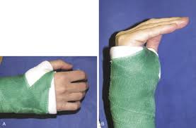 Image result for Radial Gutter Cast