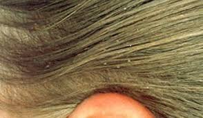 We did not find results for: Management And Treatment Of Head Lice Hertfordshire Community Nhs Trust