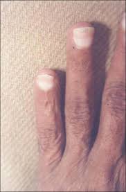 nails in systemic disease singh g