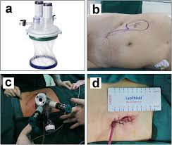 Loudest in left lateral decubitus position on expiration other clinical features of mitral stenosis may include: Robot Assisted Laparoendoscopic Single Site Surgery For The Simultaneous Management Of Multiple Urinary Tract Calculi A Case Report And Experience Sharing Bmc Urology Full Text