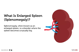 Image result for Splenomegaly