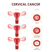 In particular, early stage cervical cancers, like precancerous changes, typically do not produce symptoms. Cervical Cancer Diagnosis And Treatment Options