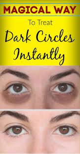 Magical Way To Treat Dark Circles Under Eyes Instantly Darkcircles Darkskincare Skincare Sk Dark Eye Circles Dark Circles Under Eyes Dark Circles Treatment