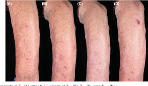 It is used to treat superficial bccs, sunspots and, sometimes, squamous cell carcinoma in situ (bowen&#x27;s disease). Five Percent 5 Fluorouracil In A Cream Or For Superficial Peels In The Treatment Of Advanced Photoaging Of The Forearms A Randomized Comparative Study Semantic Scholar