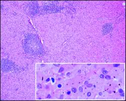 We describe a case of aosd associated with formation of granulomatous the histologic finding of granulomas formation in lymph nodes, liver or spleen should not deter the consideration of aosd as a potential. Incidental Findings In Pelvic Lymph Nodes At Radical Prostatectomy Journal Of Clinical Pathology