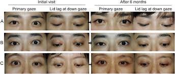 Von graefe sign (lid lag sign): Effect Of Double Fold Surgery On Spontaneous Resolution Of Graves Upper Eyelid Retraction Sciencedirect