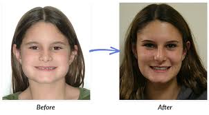 Click here to see all the before and after pictures braces cases. Before After Braces Photos Delurgio Orthodontics Delurgio Orthodontics